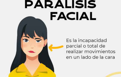 Parálisis Facial – ¿Qué es? ¿Cuál es el tratamiento?