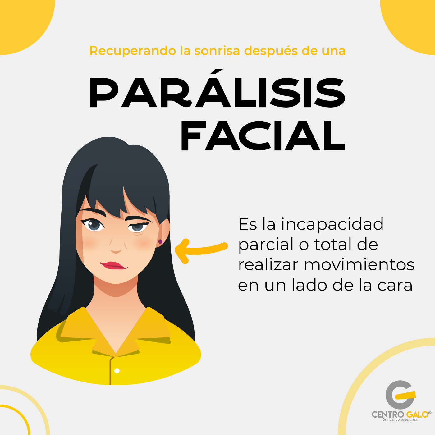 Parálisis Facial – ¿Qué es? ¿Cuál es el tratamiento?